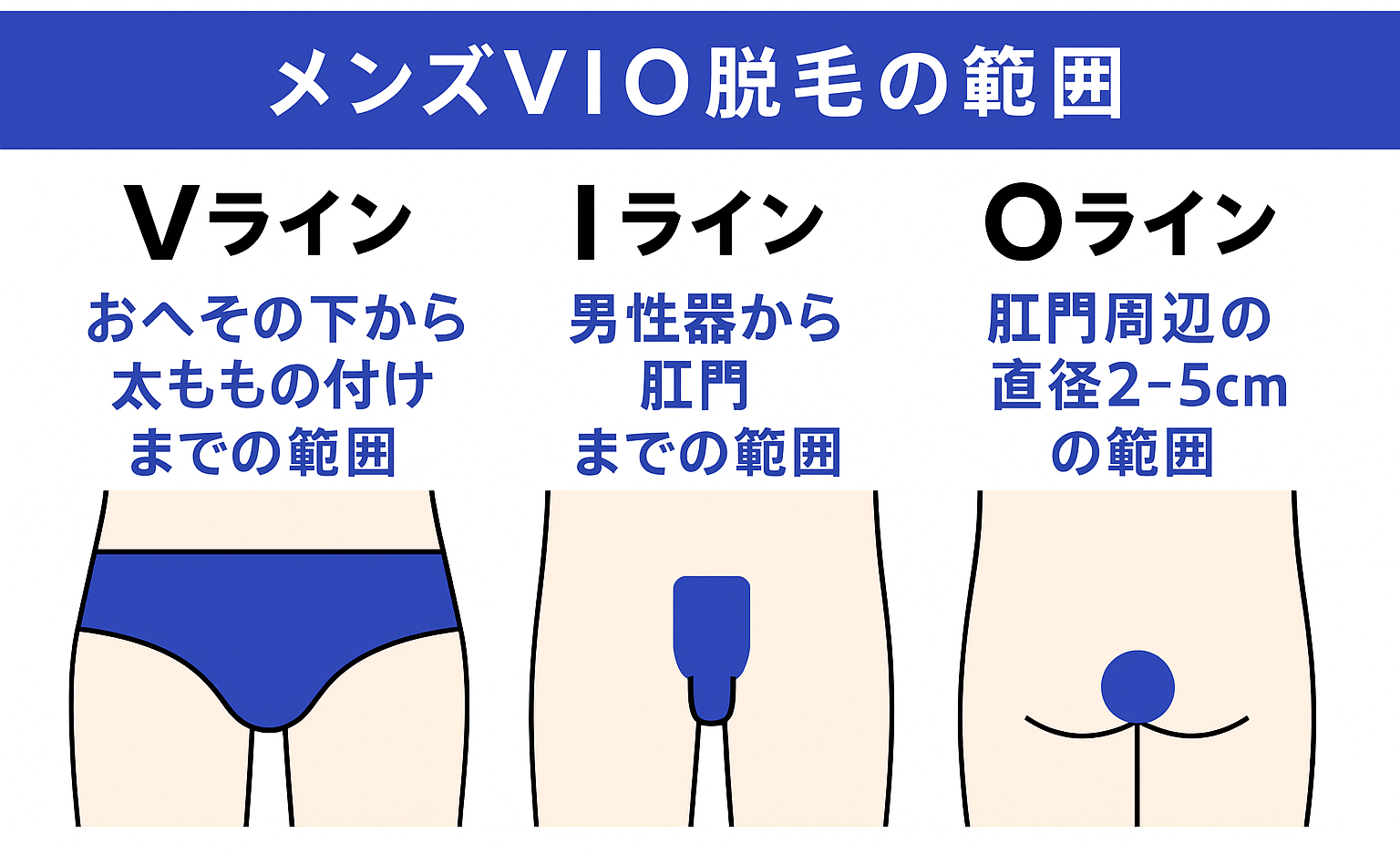 メンズVIO脱毛の範囲イラスト